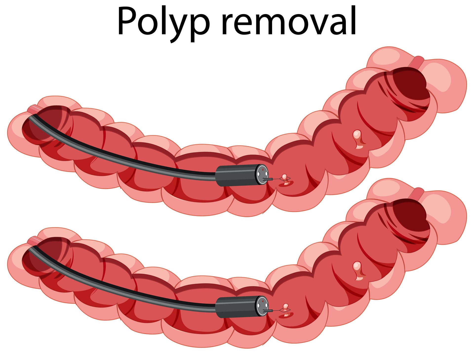 Polyp_removal (1) (1).jpg